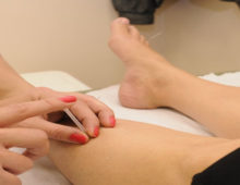 Acupuncture