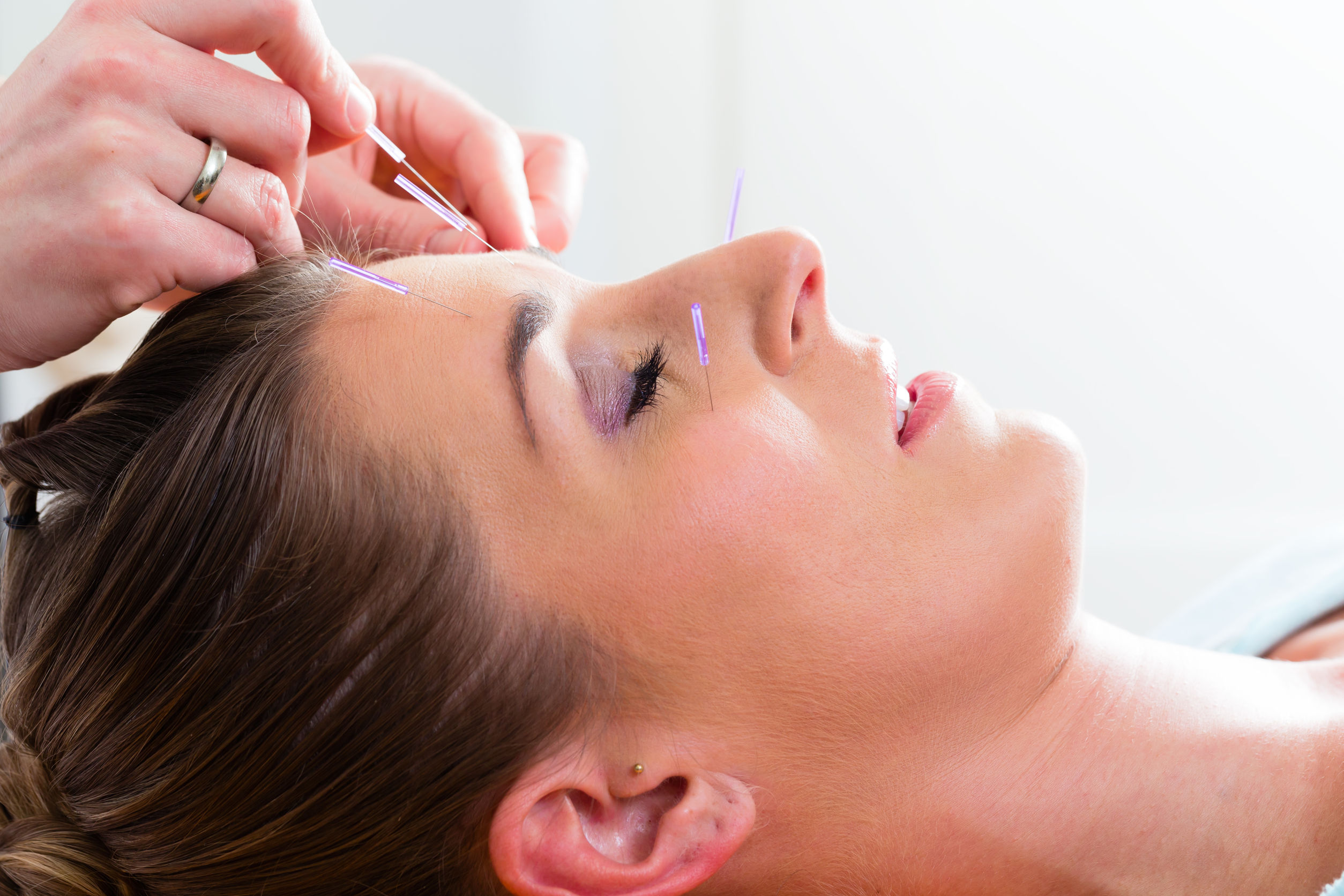 Discover facial acupuncture at the best day spa in Chicago